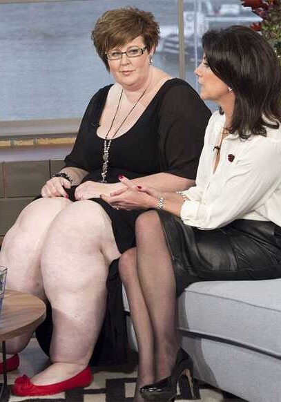 Редкое заболевание раздуло ноги женщины до 63 килограммов (Фото-Видео)