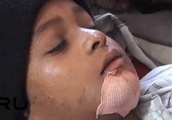 В Индии 7-летнему мальчику удалили 80 зубов (Видео)