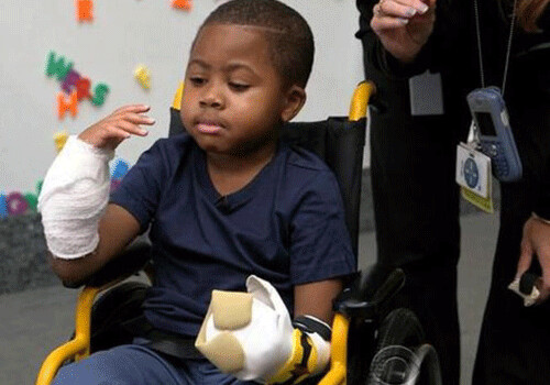 В США хирургам удалось пересадить 8-летнему мальчику кисти рук (Фото)