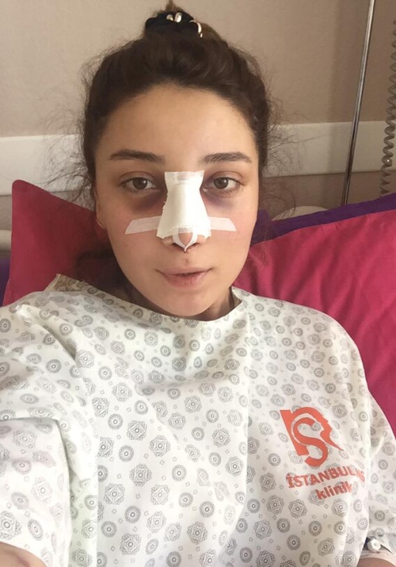 Гюнай Ибрагимли сделала пластическую операцию на нос (Фото) 