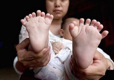 В Китае родился ребенок с 31 пальцем на руках и ногах (Фото)