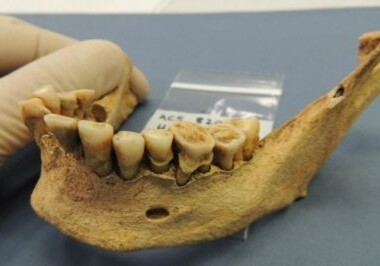Ученые разработали методику определения причины смерти по зубам