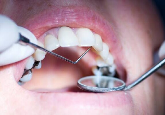 Британские ученые создали пломбы, восстанавливающие зубы