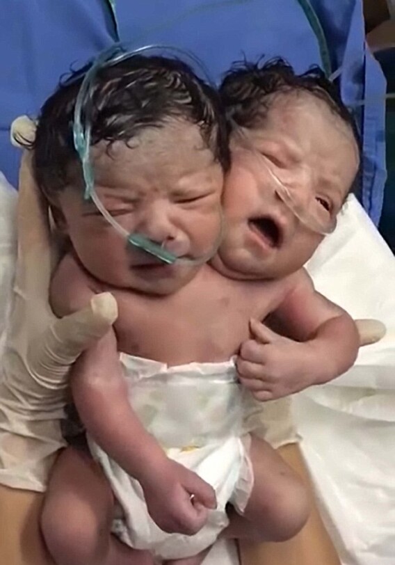 В Мексике родился ребенок с двумя головами (Фото-Видео)