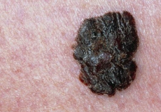 Искусственный интеллект опознает рак кожи не хуже онколога
