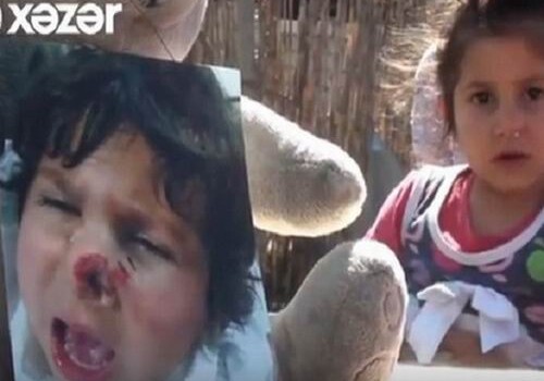 В Баку врач восстановил нос девочке, которую укусила собака (Видео)