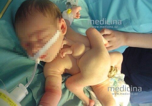 В Азербайджане родился ребенок с четырьмя руками и ногами (Фото)