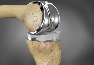 В Китае пациенту «распечатали» новое колено на 3D-принтере