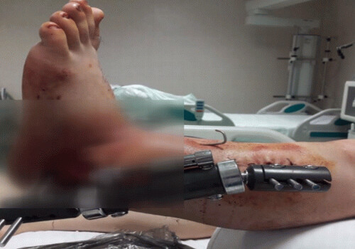 Уникальная операция в Азербайджане: Пациенту пришили отрезанную ногу (Видео)
