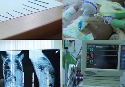 Узбекские врачи обнаружили в теле младенца 16 иголок