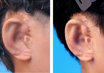 Китайские дети получили новые уши, выращенные из собственных клеток