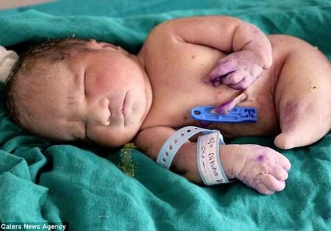 В Индии родился ребенок с «синдромом русалки» (Фото)
