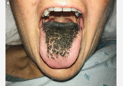 Антибиотики довели американку до черных волос на языке