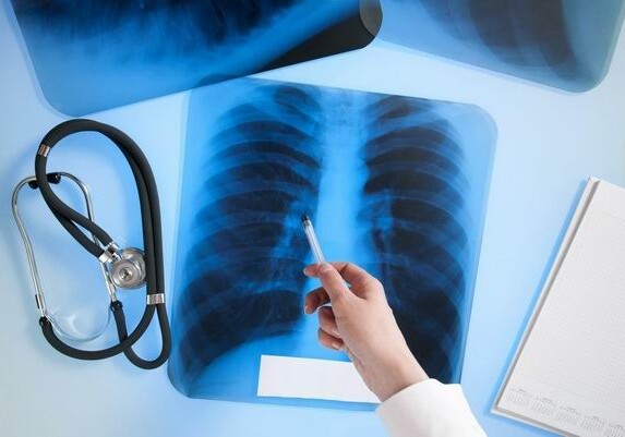 Обнародовано число больных туберкулезом в Азербайджане и районы с наибольшим их числом