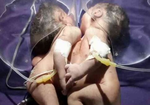 В Индии родились сиамские близнецы с одним сердцем на двоих