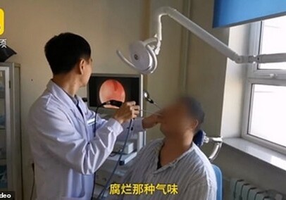 Китаец прожил 20 лет с зубом в носу (Фото)